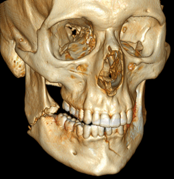 Jaw Fractures Cysts 1